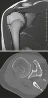 Shoulder MRI and CT