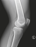 Knee Radiograph: Lateral View