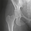 Hip Joint: Anteroposterior Radiograph
