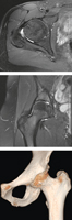 Hip MRI and 3D CT