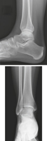 Ankle: Radiographs