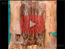  Vertebral Column and Its Contents: Step 2, Epidural space and dura mater