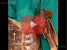  Anterior Shoulder, Pectoral Region, Breast and Brachial Plexus: Step 4, Subclavian vein and subclav