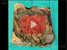  Diaphragm, Kidneys and Posterior Abdominal Wall: Step 4, Ureter and gonadal veins