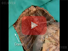  Female Pelvic Viscera: Step 1, Pelvic viscera in situ