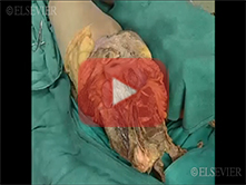  Female Pelvic Viscera: Step 6, Uterosacral and cardinal ligaments