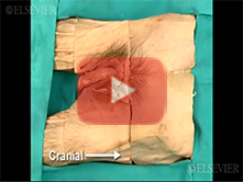  Male External Genitalia and Perineum: Step 1, Removal of skin from the perineum