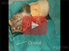  Pelvic Vasculature and Autonomic Innervation: Step 4, Middle sacral artery, common iliac artery and