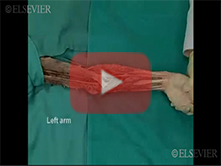  Flexor Surface of the Forearm: Step 2, Median nerve and brachial artery in the cubital fossa
