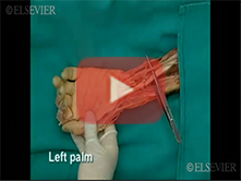  Palm : Step 1, Approach to the palm, palmaris longus, palmar aponeurosis