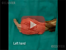  Extensor Surface of the Forearm and Dorsum of the Hand: Step 7, Extensor apparatus; lumbrical and i