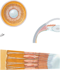 Lens, Zonular Fibers and Ciliary Body