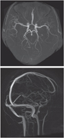 Cranial Arteries and Veins: MRA and MRV