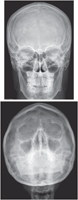 Skull: Radiographs