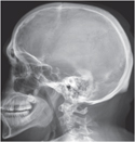Skull: Lateral Radiograph