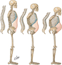 Osteoporosis