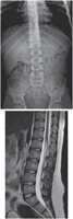 Vertebral Column: Radiograph and MRI