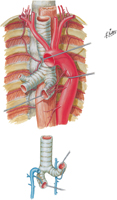 Bronchial Arteries and Veins