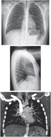 Thorax: Radiographs and CT Angiogram