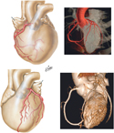 Coronary Arteries: Imaging