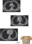 Thorax: Axial CT Images