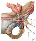 Indirect Inguinal Hernia