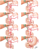 Celiac Trunk: Variations