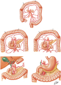 Colic Arteries: Variations II