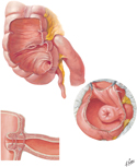 Cecum and Ileal Orifice