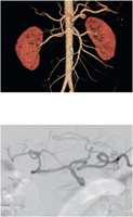 CT Angiogram of Abdominal Aorta and Celiac Arteriogram