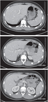 Abdomen: Axial CT Images of Upper Abdomen