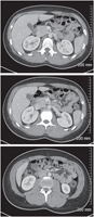 Abdomen: Axial CT Images of Midabdomen