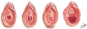 Hymen: Variations