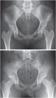 Pelvis: Radiographs of Female and Male