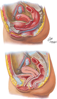 Pelvic Viscera and Perineum: Female