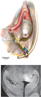 Broad Ligament and Hysterosalpingography