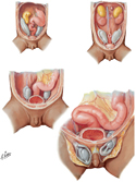 Descent of Testis