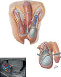 Scrotum and Contents
