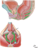 Perineal, Retropubic, and Infraperitoneal Spaces