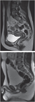 Pelvis: Sagittal T2-Weighted MRIs