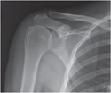 Shoulder: Anteroposterior Radiograph