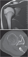 Shoulder: MRI and CT Image