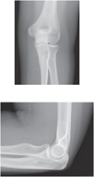 Elbow: Radiographs
