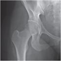 Hip Joint: Anteroposterior Radiograph