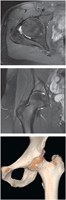 Hip Joint: MRI and CT 3D Reconstruction