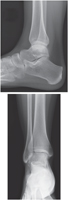 Ankle: Radiographs