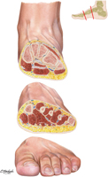 Foot: Coronal Sections
